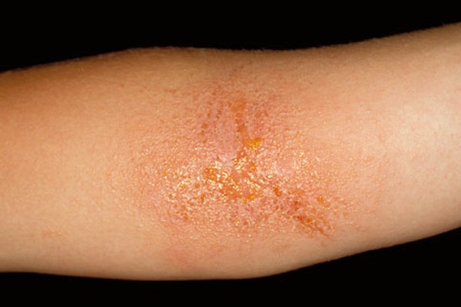 Do you get poison oak? Read this……. – American Mining Rights Association